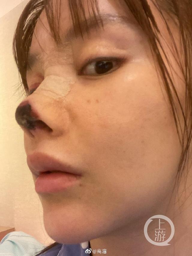 高溜因整容失败原因(女演员高溜自曝整形致鼻尖坏死)(2)