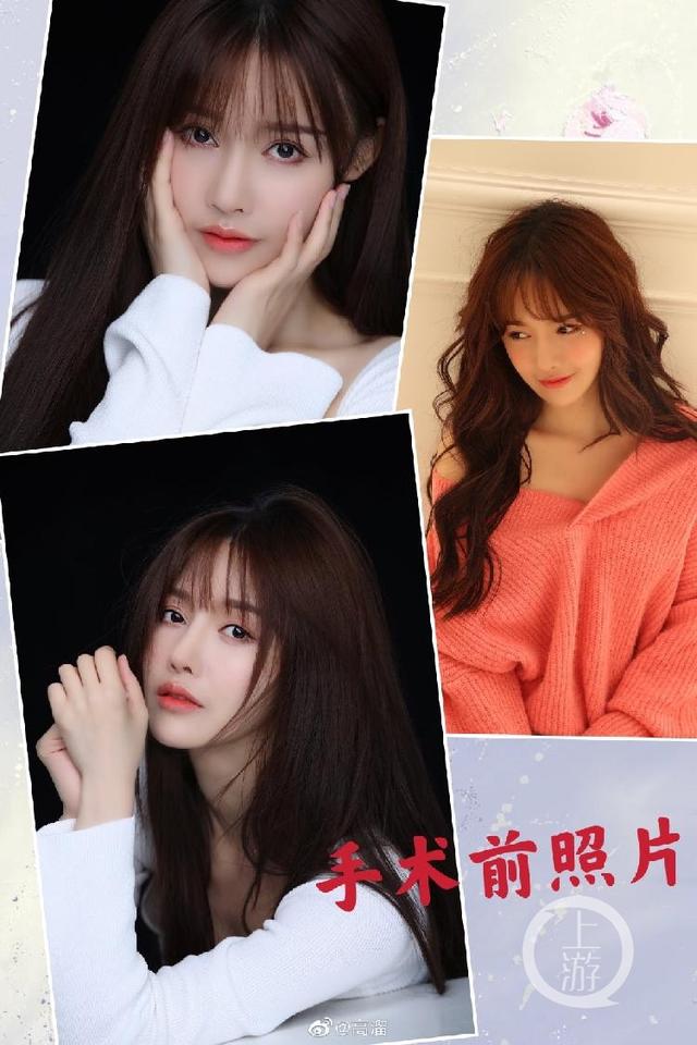 高溜因整容失败原因(女演员高溜自曝整形致鼻尖坏死)(1)